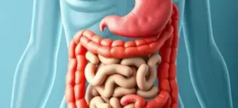 doença inflamatória intestinal